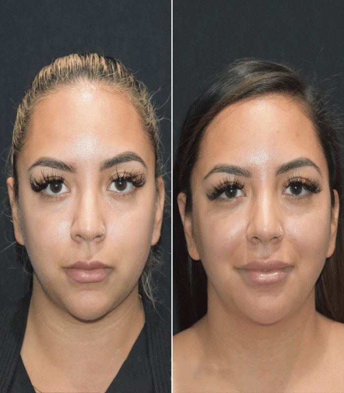 بلفاروپلاستی