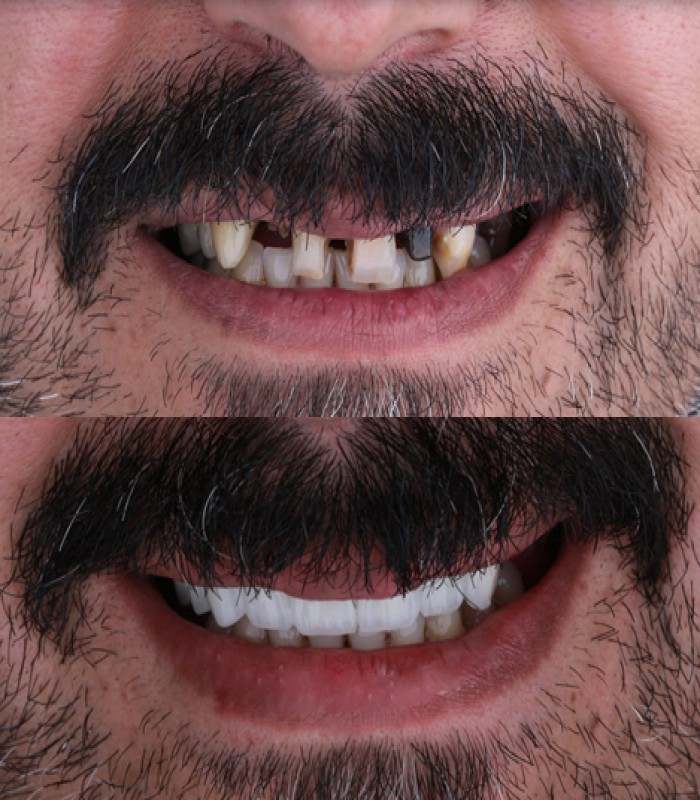 ایمپلنت یک روزه