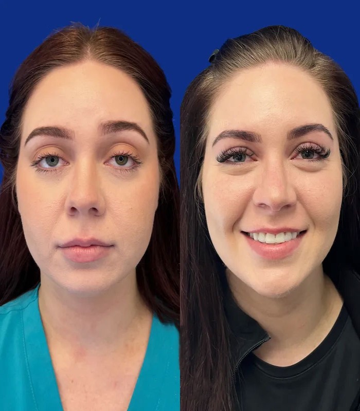 بلفاروپلاستی