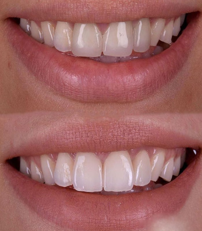 رروکش زیرکونیا