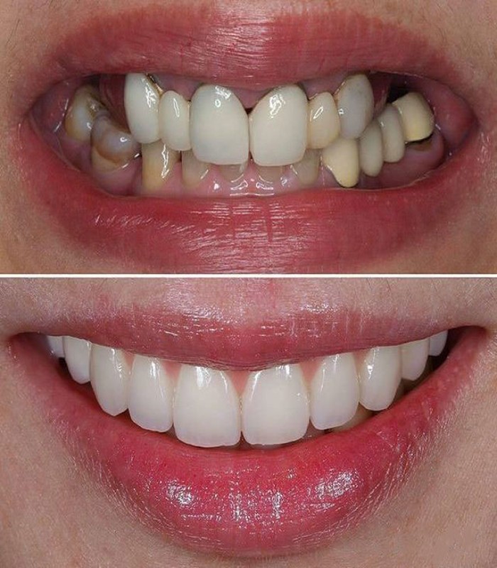 روکش زیرکونیا