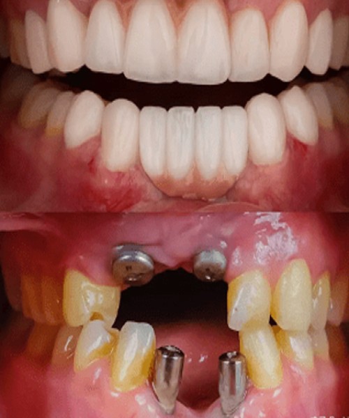 ایمپلنت یک روزه