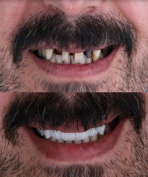 ایمپلنت دیجیتال قبل و بعد