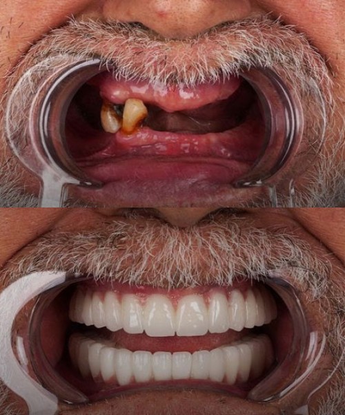 ایمپلنت فول فک