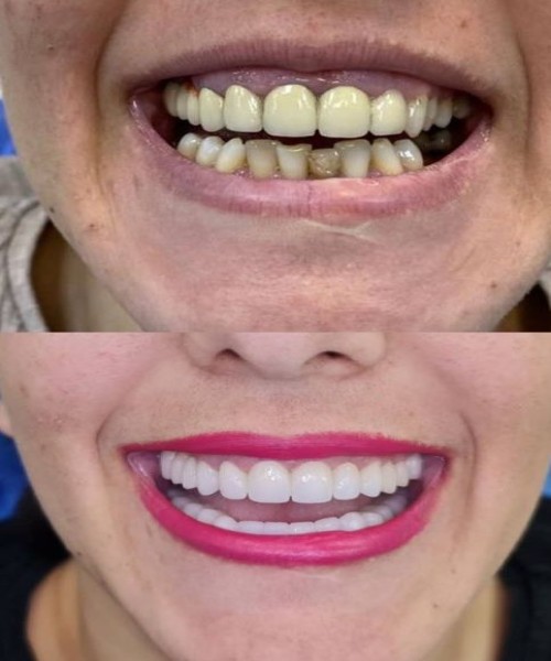 روکش زیرکونیا