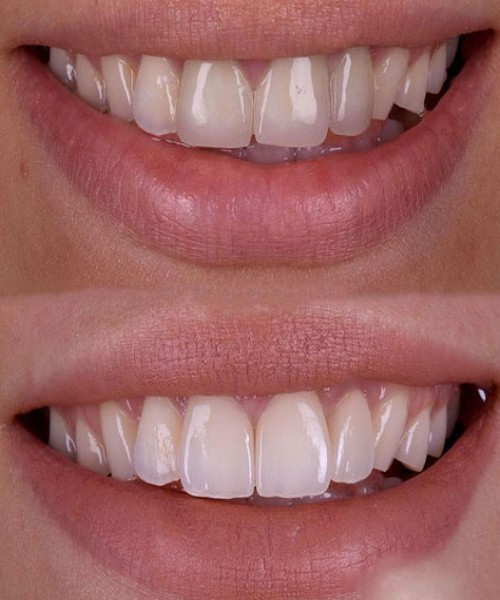 رروکش زیرکونیا