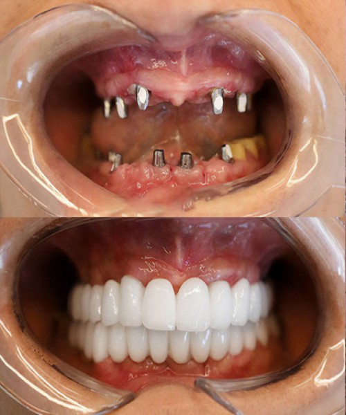 ایمپلنت دیجیتال قبل و بعد
