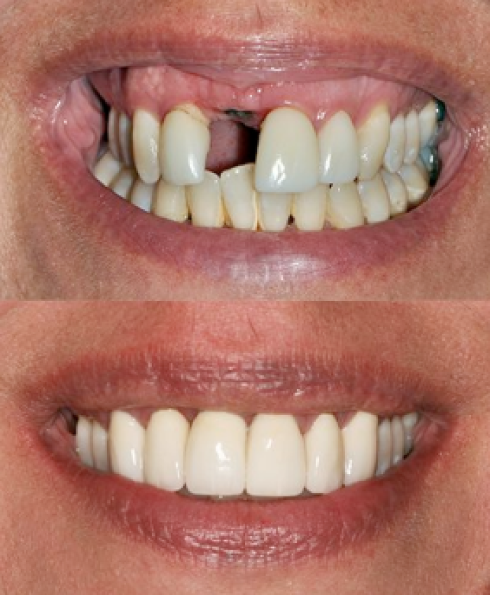 ایمپلنت یک روزه