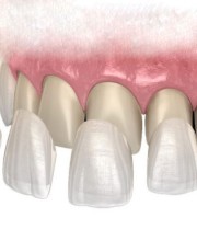 روکش زیرکونیا