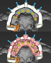 ایمپلنت تمام دیجیتال