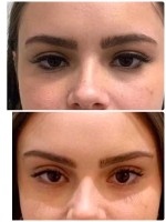 لیفت ابرو و پیشانی